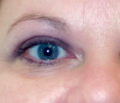 Eyelid Surgery Before & After Results
