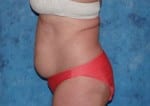 Abdominoplasty (Tummy Tuck)