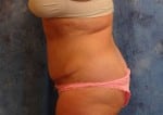 Abdominoplasty (Tummy Tuck)