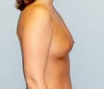 Breast Augmentation