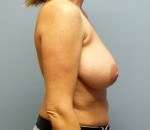 Breast Lift without Implant