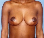 Breast Reduction-Female