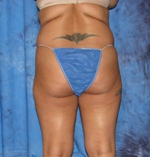 Brazilian Butt Lift