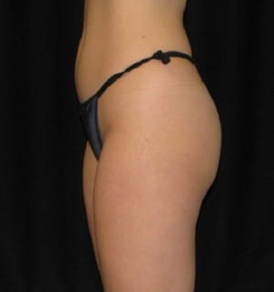 Brazilian Butt Lift