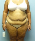 After Weight Loss Surgery and Overweight