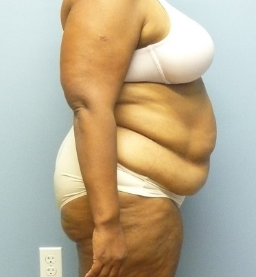 After Weight Loss Surgery and Overweight