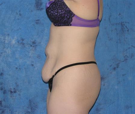 Mini-abdominoplasty (Mini- Tummy Tuck)