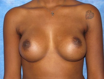 Breast Augmentation