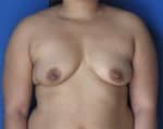 Breast Augmentation