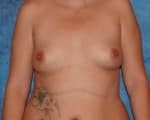 Breast Augmentation