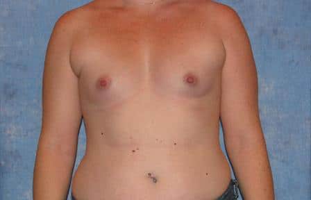 Breast Augmentation