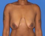 Breast lift with implants