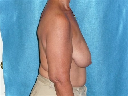 Breast Lift without Implant