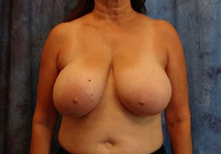 Breast Reduction-Female