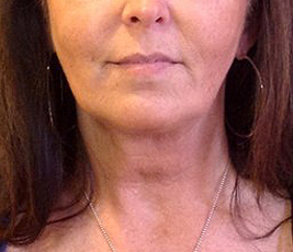 Laser Facelift with PrecisionTx