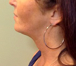 Laser Facelift with PrecisionTx