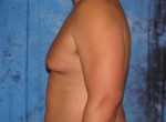 Breast Reduction-Male