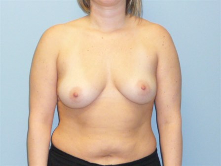 Breast Asymmetry correction