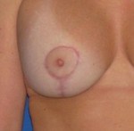 Breast Scars