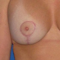 Breast Scars