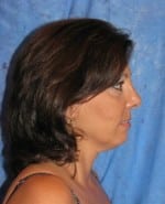 Laser Facelift with PrecisionTx