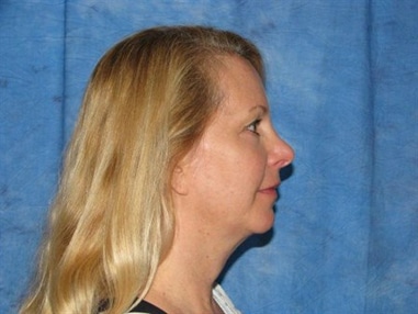 Laser Facelift with PrecisionTx