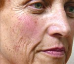 Laser Facial Treatments