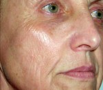 Laser Facial Treatments
