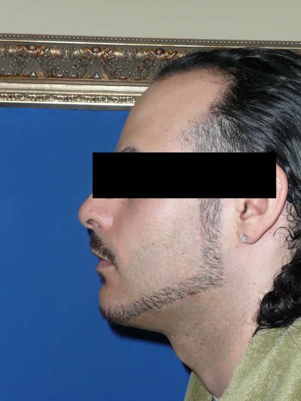 Chin Implant