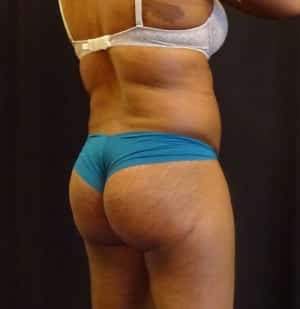 Brazilian Butt Lift