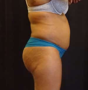 Brazilian Butt Lift