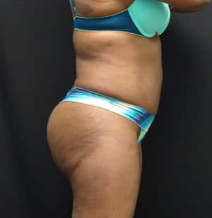 Brazilian Butt Lift