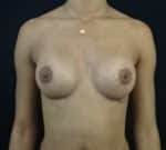 Breast Augmentation