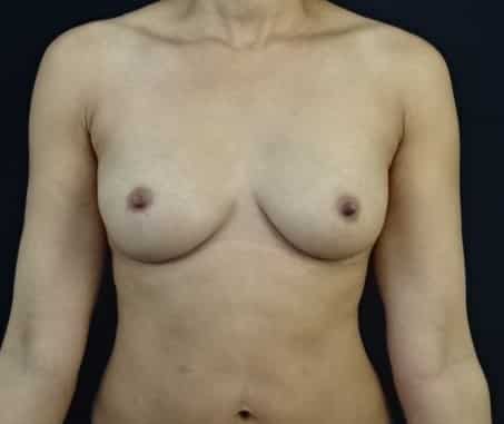 Fat Transfer Breast Augmentation