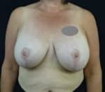 Breast Lift with Implant