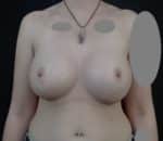 Breast Augmentation