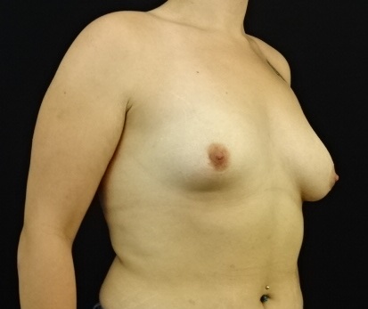 Breast Asymmetry correction