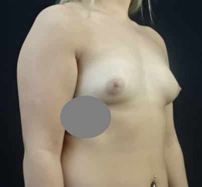 Breast Augmentation