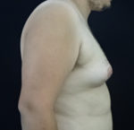 Breast Reduction-Male