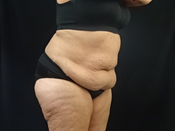 Abdominoplasty (Tummy Tuck)