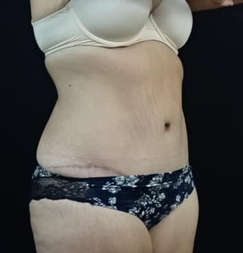 Abdominoplasty (Tummy Tuck)