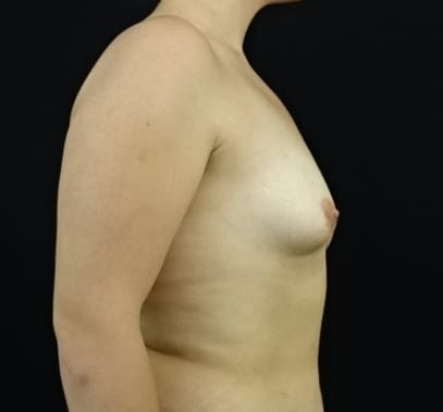 Breast Asymmetry correction