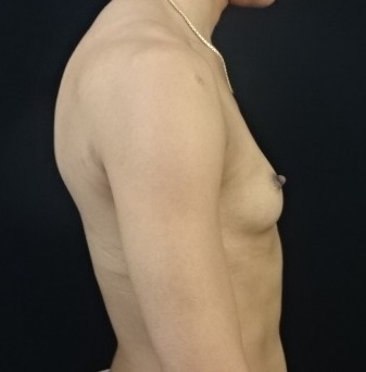 Transgender Female Breast Augmentation