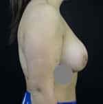 Breast Augmentation