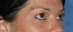 Blepharoplasty