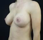 Breast Lift with Implant