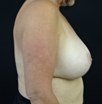 Breast Lift with Implant