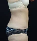 Abdominoplasty (Tummy Tuck)