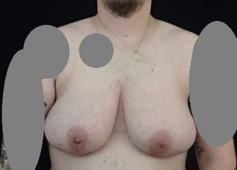 Transgender Male Chest Masculinization Surgery