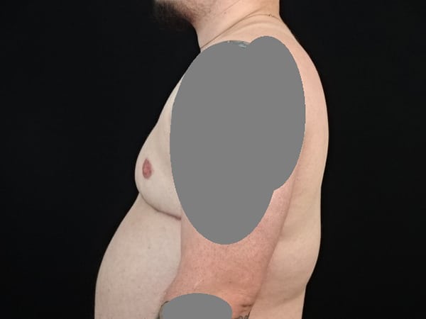 Transgender Male Chest Masculinization Surgery